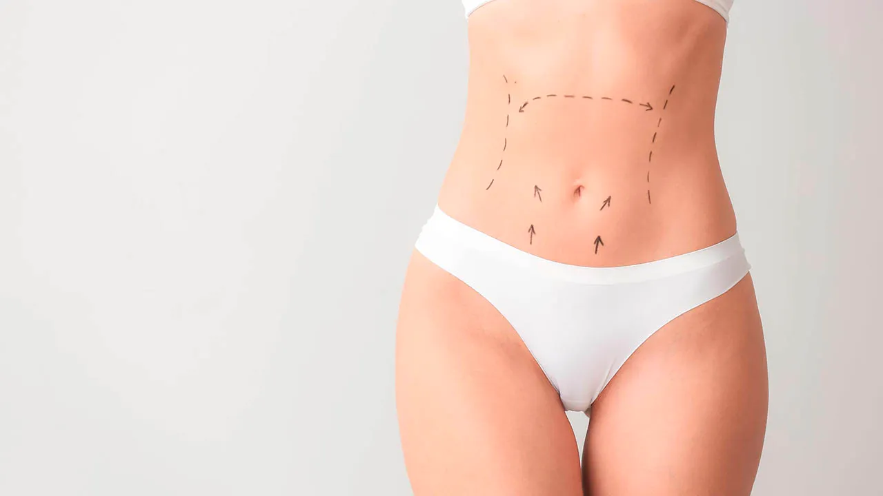 Abdominoplastia sem drenos: conheça a técnica que diminui complicações no pós-operatório