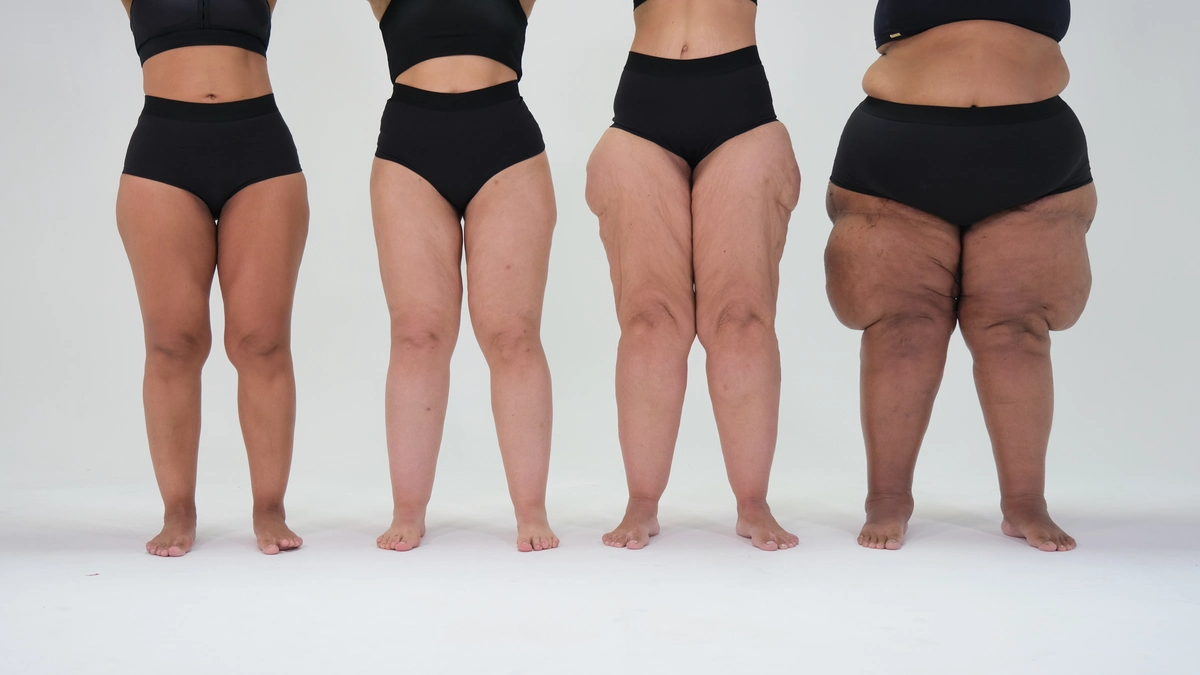 Lipedema: diagnóstico precoce é essencial para conter a progressão da doença